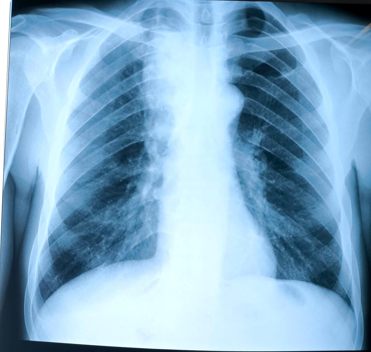 Mechanical ventilation